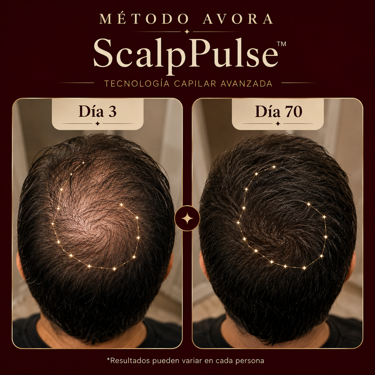 AVORA ScalpPulse™ | Tecnología Capilar Avanzada con Luz Infrarroja